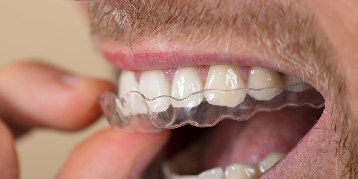 Achieving Your Ideal Smile: The Personalised Approach with Invisalign