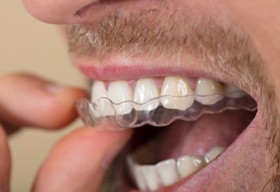 Achieving Your Ideal Smile: The Personalised Approach with Invisalign