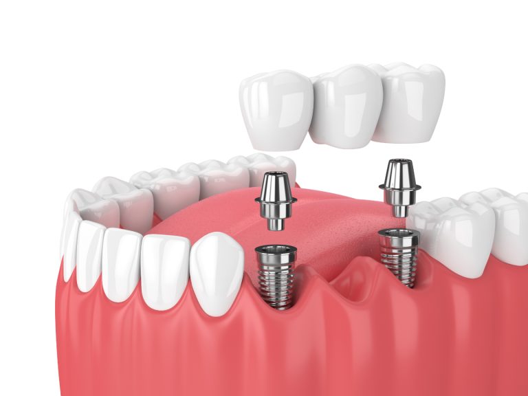 Empowering Dental SEO Through Neuro-Linguistic Programming Techniques